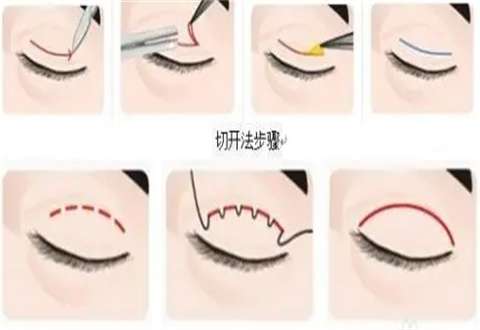 全切双眼皮多久能恢复正常？整理维持时间＋适合人群等，一键进入