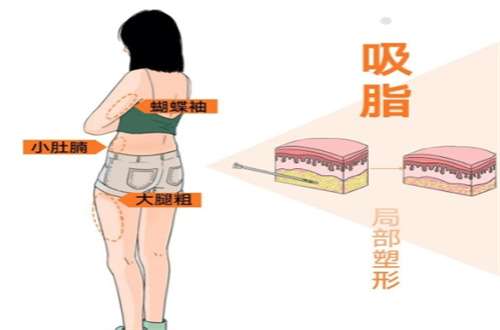 吸脂2.jpg