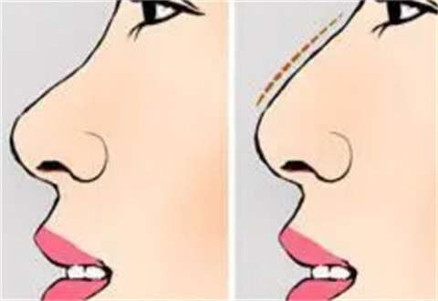 假体隆鼻有没有风险？优势/护理/适合人群更新了~